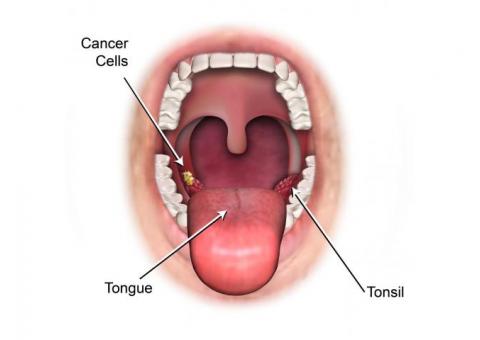 Tonsil Cancer Surgeon in India – headneckdoctor.com