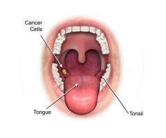 Tonsil Cancer Surgeon in India – headneckdoctor.com