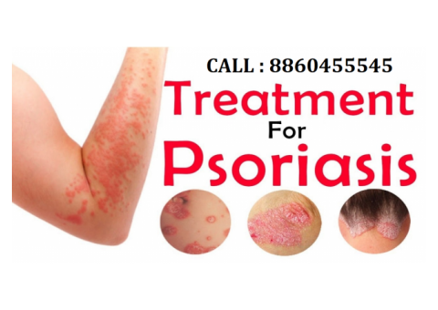 PH: 8860455545 : Psoriasis treatment in Deoria sadar up