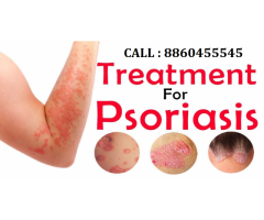 PH: 8860455545 : Psoriasis treatment in Deoria sadar up