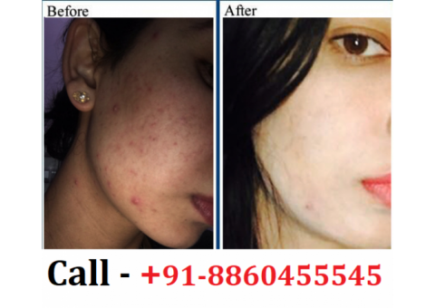 Best Skin Specialist Clinic in Aunrihar || 8860455545