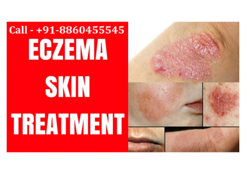 Call :: 8860455545 :: Eczema skin treatment in Pipraich