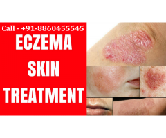 Call :: 8860455545 :: Eczema skin treatment in Pipraich