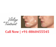 8860455545 || Vitiligo treatment in Pratappur sugar factory