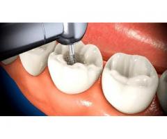 Root Canals Can Impart A Healthy Smile
