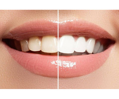 BRIGHTEN YOUR SMILE: EXPLORING THE LATEST TEETH WHITENING TECHNOLOGIES AVAILABLE IN THANE