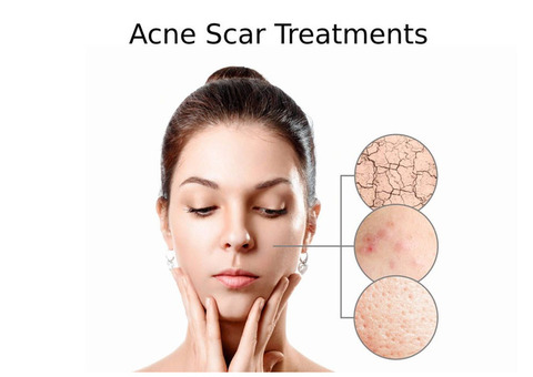 Acne Scar Treatments