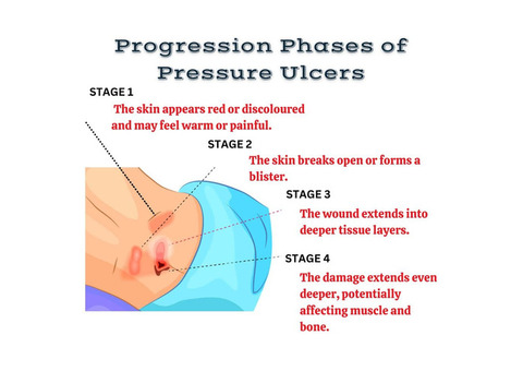 Progression phases of pressure ulcers | Synerheal Pharmaceuticals