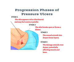 Progression phases of pressure ulcers | Synerheal Pharmaceuticals