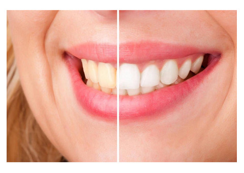 THE BENEFITS OF PROFESSIONAL TEETH WHITENING IN THANE