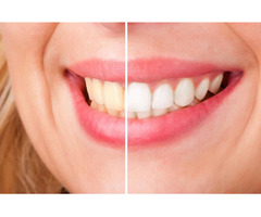 THE BENEFITS OF PROFESSIONAL TEETH WHITENING IN THANE