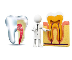 UNDERSTANDING THE ROOT CANAL PROCEDURE: WHAT PATIENTS IN THANE NEED TO KNOW