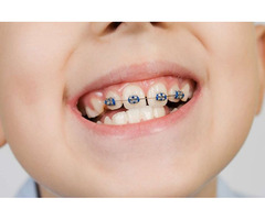 WHEN SHOULD KIDS IN THANE GET THEIR FIRST ORTHODONTIC CHECK-UP?