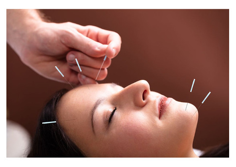 How Acupuncture for Migraine in Mumbai is Transforming Pain Management!!