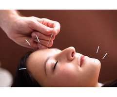 How Acupuncture for Migraine in Mumbai is Transforming Pain Management!!