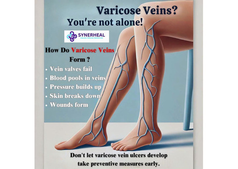 Dont Let Varicose Vein Ulcers Develop Treat At Right Time! | Synerheal Pharmaceuticals