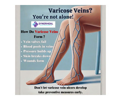 Dont Let Varicose Vein Ulcers Develop Treat At Right Time! | Synerheal Pharmaceuticals