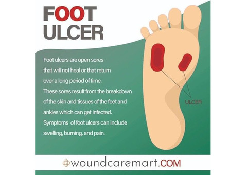 No More Worries About Foot Ulcer! | Woundcaremart